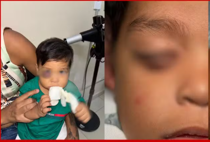 Criança de 1 ano passa por cirurgia complexa para reconstruir pálpebra em hospital do DF